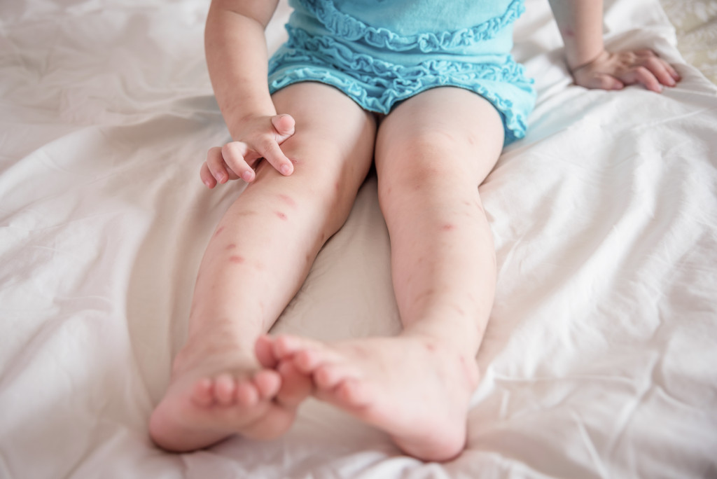 child with mosquito bites