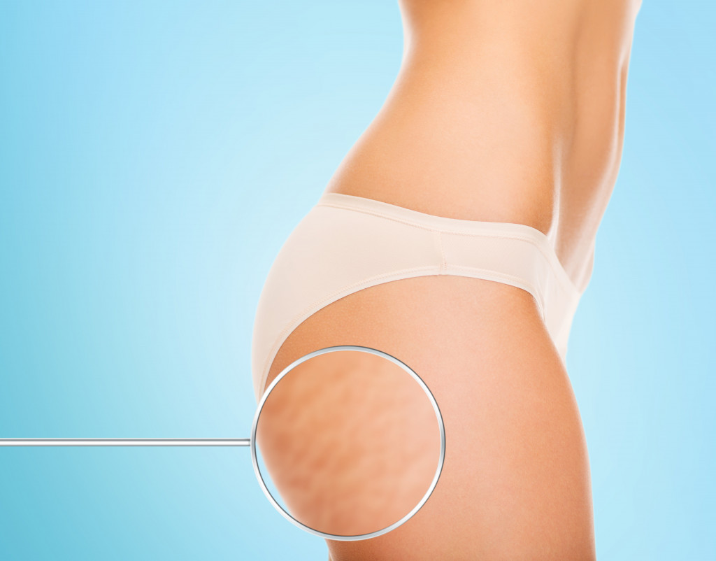 Closeup of cellulite